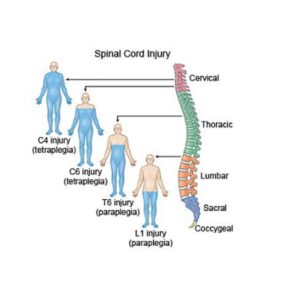 Spinal Cord Injury Attorneys - Brown & Crouppen Law Firm